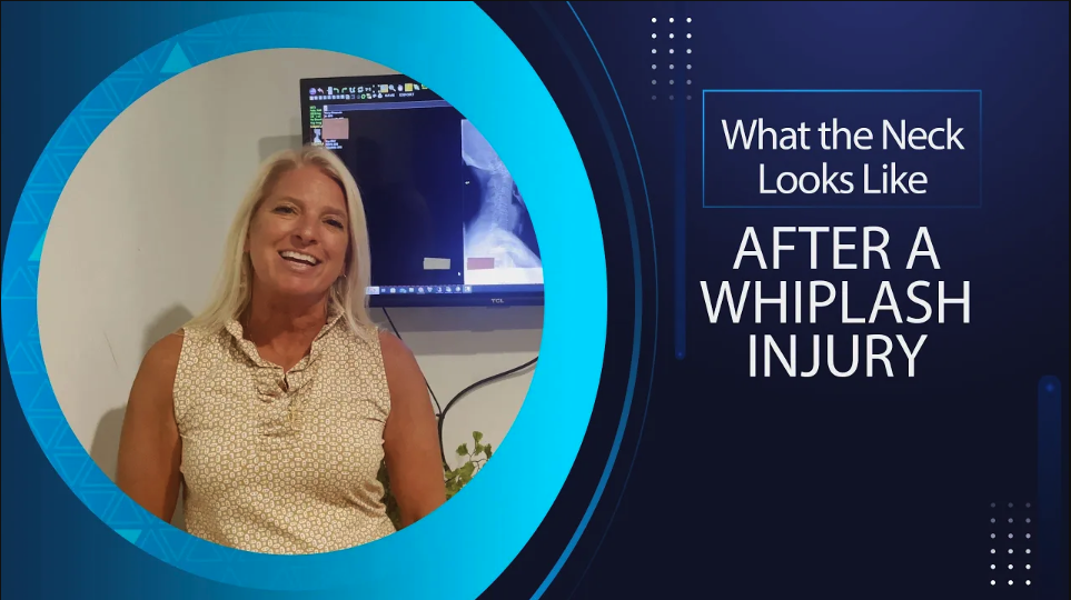 What the Neck Looks Like After a Whiplash Injury | Chiropractor for Whiplash in Belmar, NJ