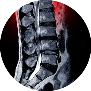 Spinal Stenosis Treatment Near Me in Belmar, NJ. Chiropractor For Spinal Stenosis Pain Relief.